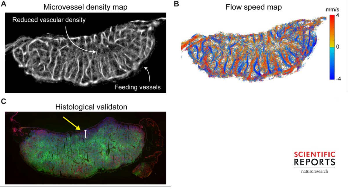 A) Super-resolution images show that the center of tumors have a smaller number of blood vessels. These vessels are chaotic and disorganized. B) Blood flow speed maps show slow and inefficient microbubble movement within these tumors. Red indicates higher flow and blue indicates lower flow. C) Histology confirms a low number of blood vessels (red color) and poor oxygen delivery (green color).