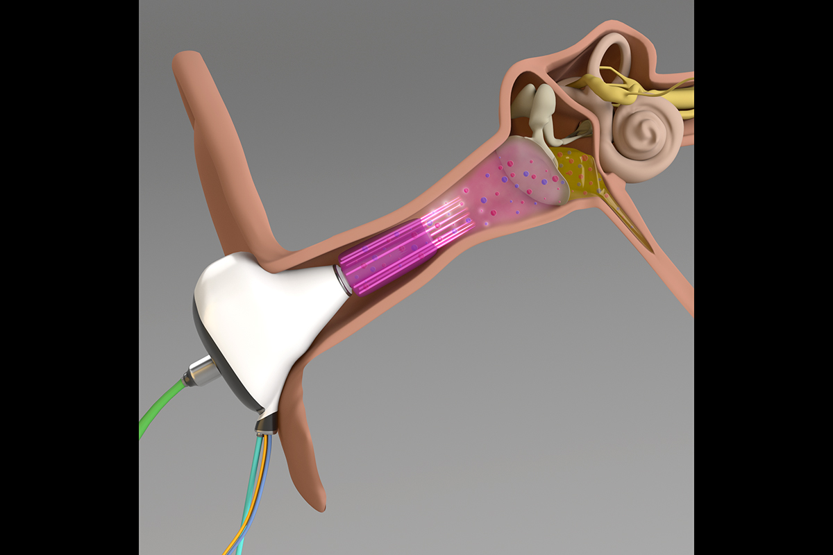 Researchers suggest that microplasma can be delivered to the human eardrum with a device that attaches to an otoscope speculum, a standard diagnostic tool for problems in the ear. Image courtesy Peter P. Sun, Jungeun (Jenny) Won, Thanh H. (Helen) Nguyen, J. Gary Eden and Stephen Boppart. Illustration generated with help from the Beckman Institute for Advanced Science and Technology&rsquo;s Visualization Laboratory. npj Biofilms and Microbiomes, 7(48), 1 (2021).