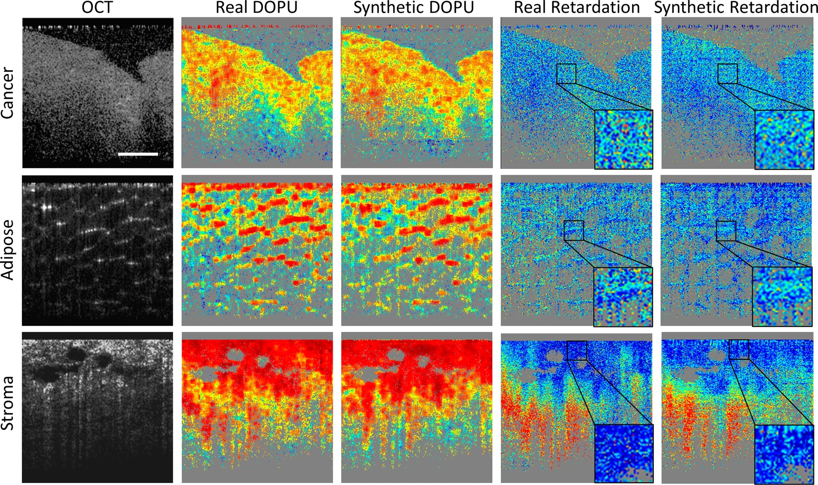 Representative computational PS-OCT images from cancer, adipose, and stroma tissue specimens, compared with the real PS-OCT images. Source: npj Digital Medicine