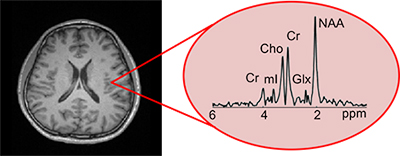 The imaging technology Fan Lam and colleagues are developing allows researchers to map biochemical profiles of the brain at an unprecedented high resolution, adding another dimension of information to the anatomical information obtained from standard MRI exams, on left.