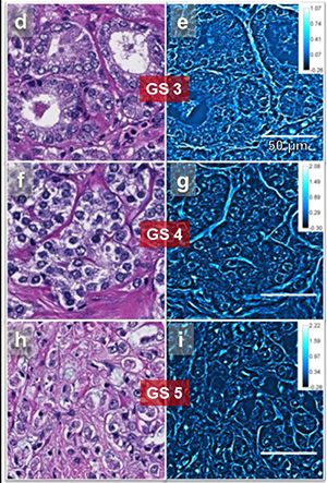 A side-by-side comparison of H&E stain (left) and SLIM (right) images of the same tissue microarray cores show that SLIM images reveal valuable information about the tissue due to the intrinsic contrast. Single strands of stroma stand out in SLIM images as opposed to the uniform pink distribution seen in H&E images.