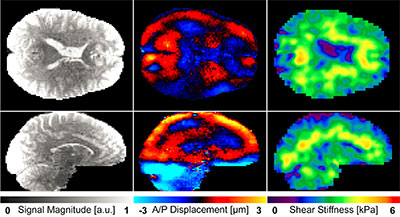 Magnetic Resonance Elastography (MRE) of the brain uses magnetic resonance imaging to measure brain stiffness. Using an optimized, non-invasive MRE acquisition and leveraging multidisciplinary research teams at the Beckman Institute, Sutton and his colleagues are able to measure the stiffness of the brain and have found significant relationships with disease process, memory performance, and aging.